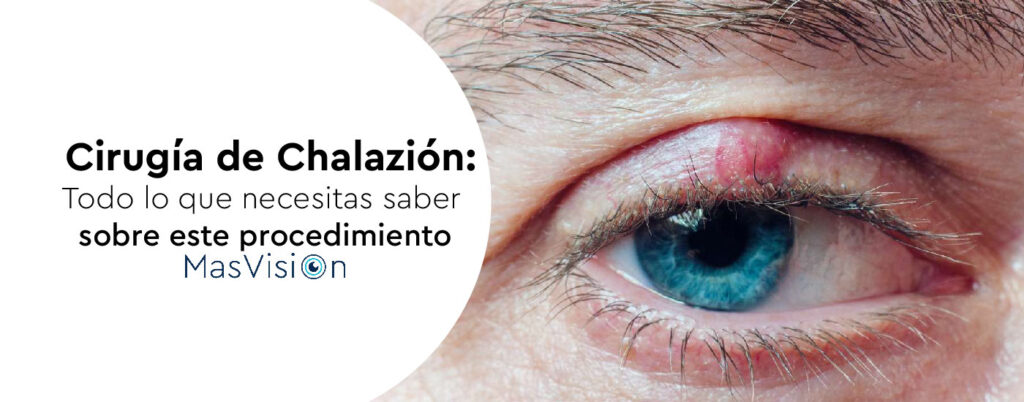 Cirugía de Chalazión: Todo lo que necesitas saber sobre este procedimiento
