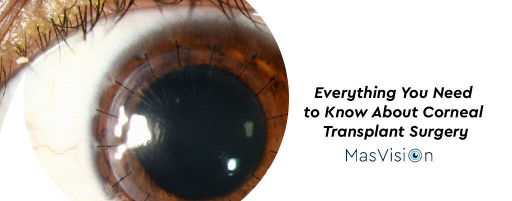 Everything You Need to Know About Corneal Transplant Surgery_Imagen 1