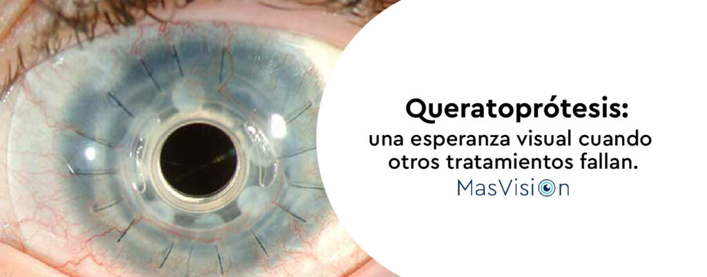 Queratoprosis en Medellín | Cirugía de córnea artificial en MasVision