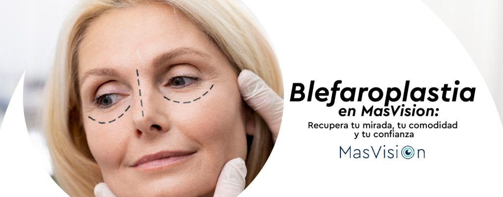 ¿Qué es la blefaroplastia y por qué es tan solicitada?